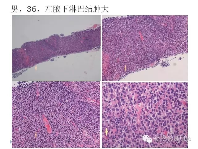 关于套细胞淋巴瘤的总结课件