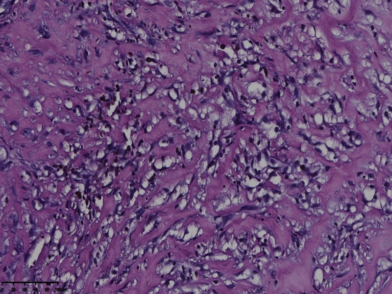 睾丸鞘膜肿物伴鞘膜积液