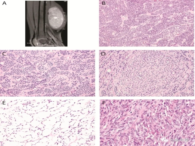 具有PDZRN3-RAF1基因易位并共表达S100和CD34的梭形细胞肿瘤