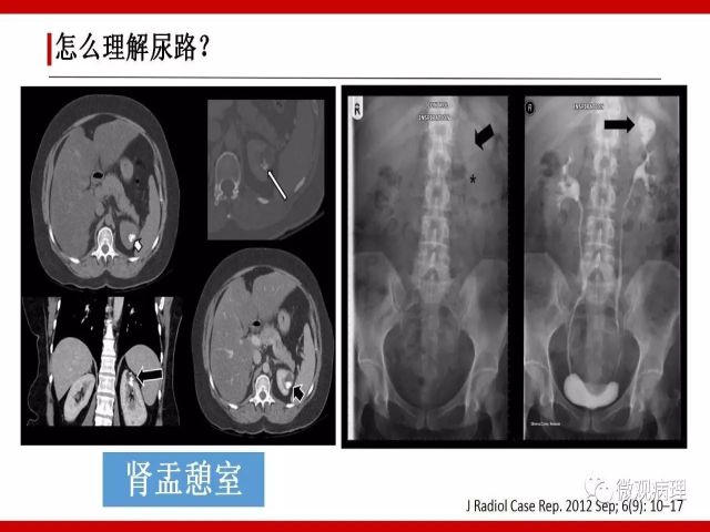 泌尿课程/尿路腺样病变的诊断要点