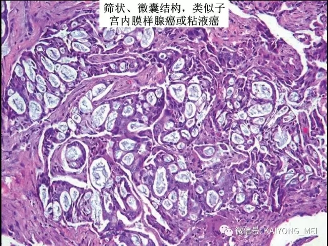 卵巢癌的病理诊断新进展（一）