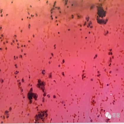 低级别黏液性肿瘤转移到卵巢伴腹腔假黏液瘤形成【小车】分享；【刘从容】老师讲解