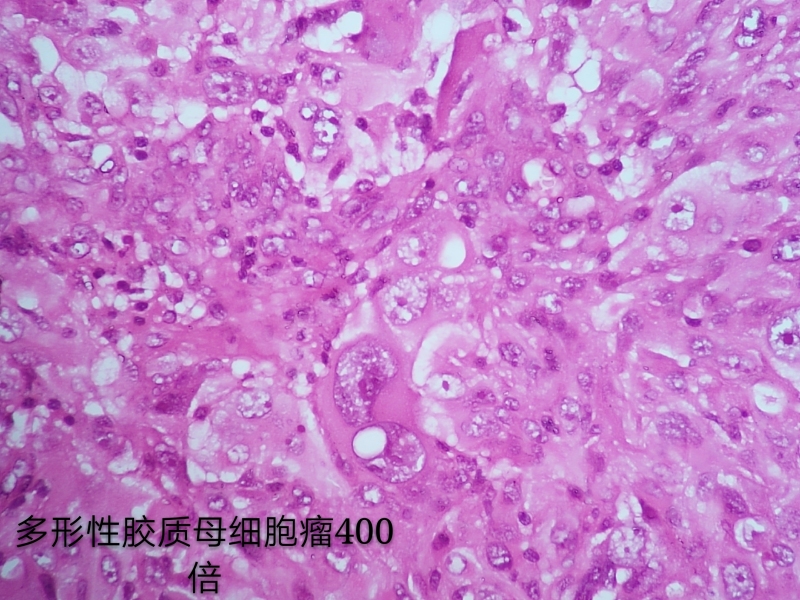 病理科工作札记（三十八）胶质母细胞瘤