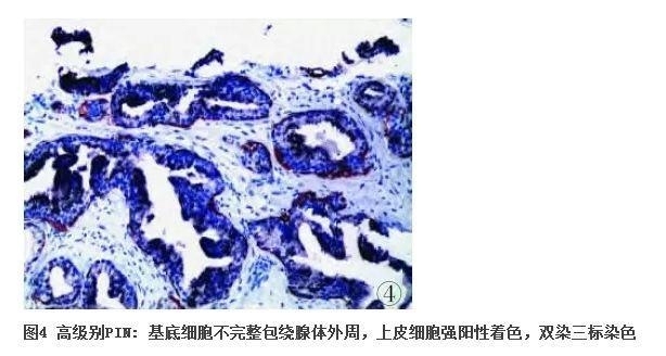 前列腺疾病的免疫组化诊断