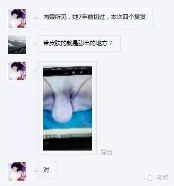 外阴侵袭性血管黏液瘤（刘从容老师分享、讲解）