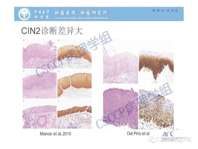 宫颈癌前病变中的诊断难点及阴道镜中ECC的 应用价值