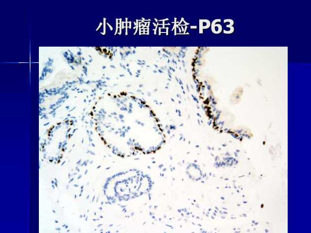 前列腺病理诊断线索（下）——黄教悌