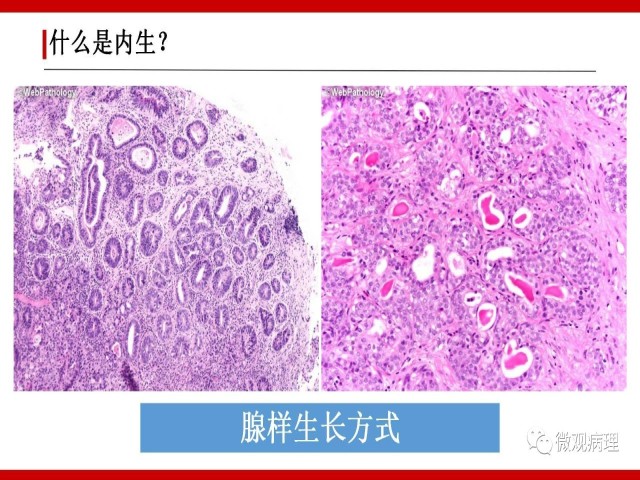 泌尿课程/尿路上皮病变的基本生长方式