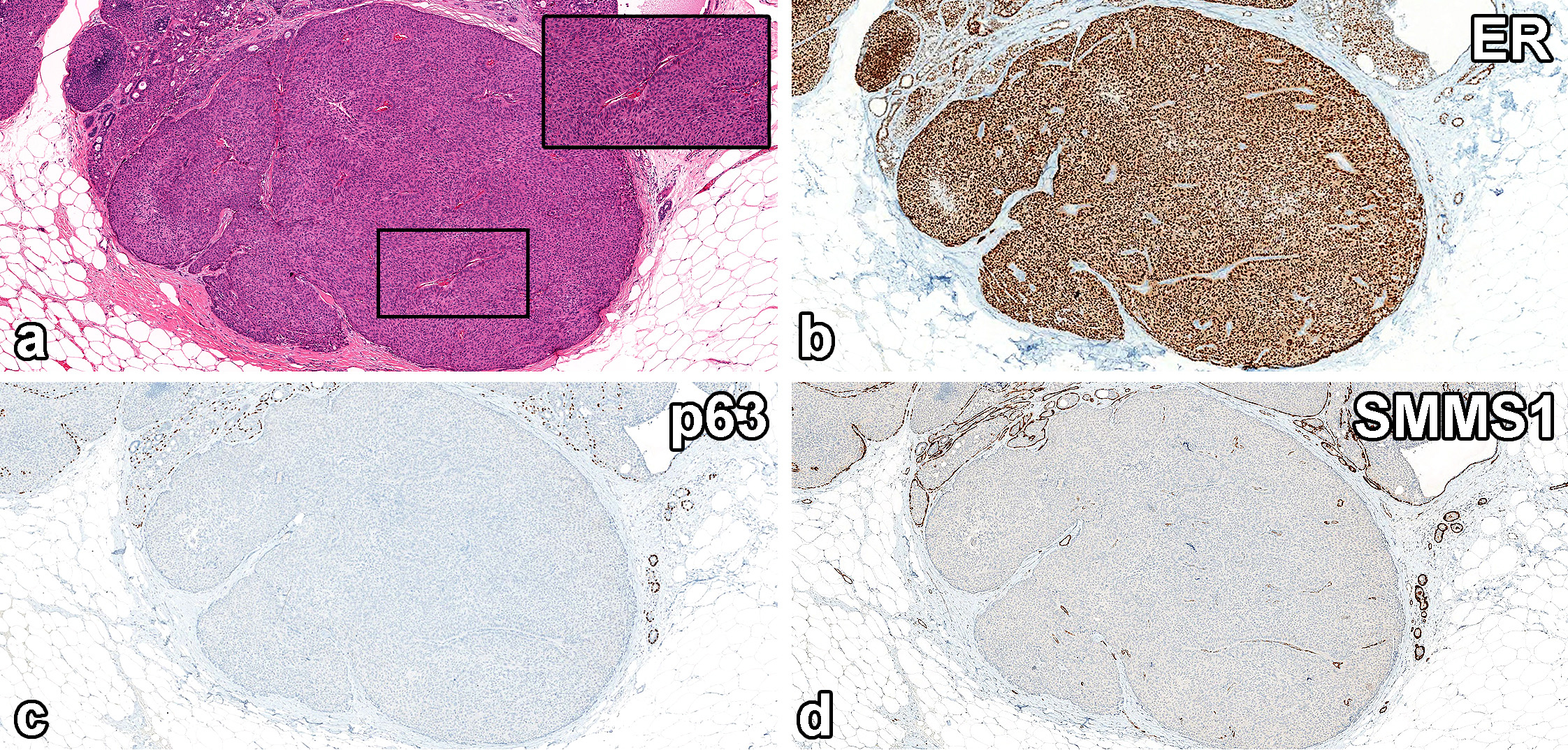 读文献，学病理-乳腺乳头状肿瘤难点总结（一）