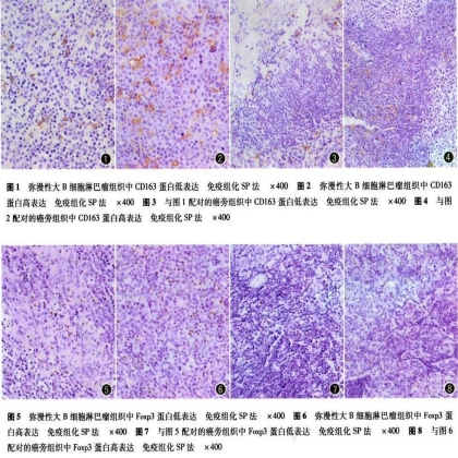 “巨噬细胞”大结局——淋巴瘤相关巨噬细胞