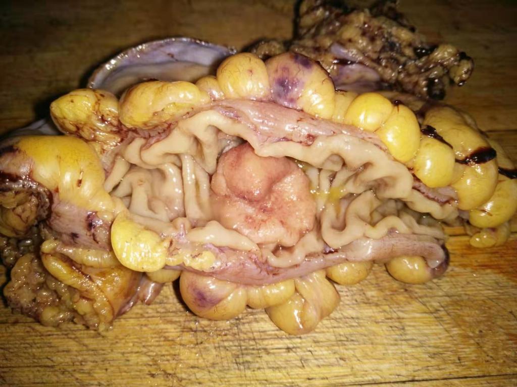 腺瘤是可以癌变的-病理科工作札记（五十四）