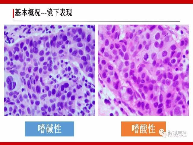 泌尿课程/浸润性尿路上皮癌病理学类型