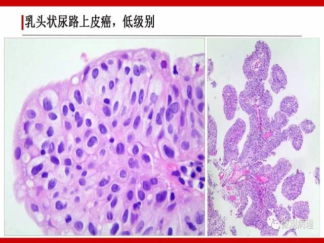 泌尿课程/非浸润性尿路上皮肿瘤诊断公式