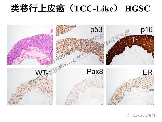 中华病理学会基层培训遵义站讲座（一）——卵巢和输卵管浆液性肿瘤的诊断和鉴别诊断