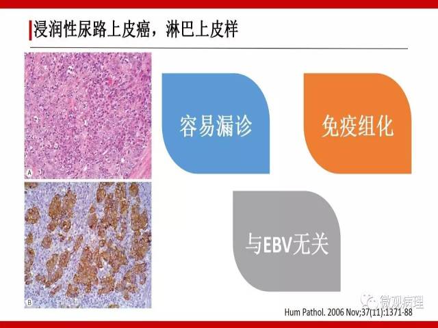泌尿课程/浸润性尿路上皮癌病理学类型