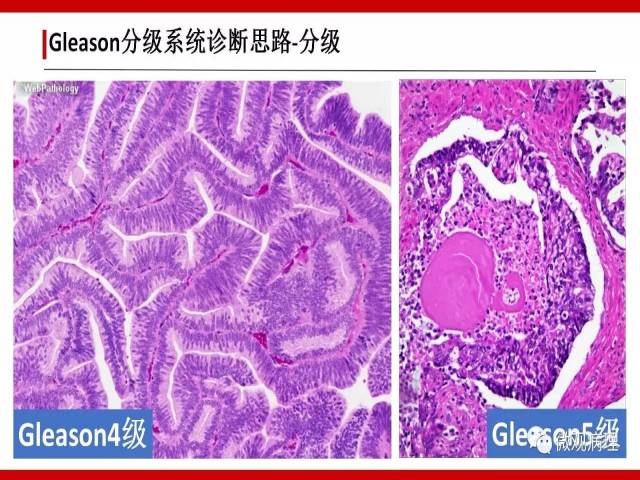 前列腺癌Gleason分级系统的前世今生