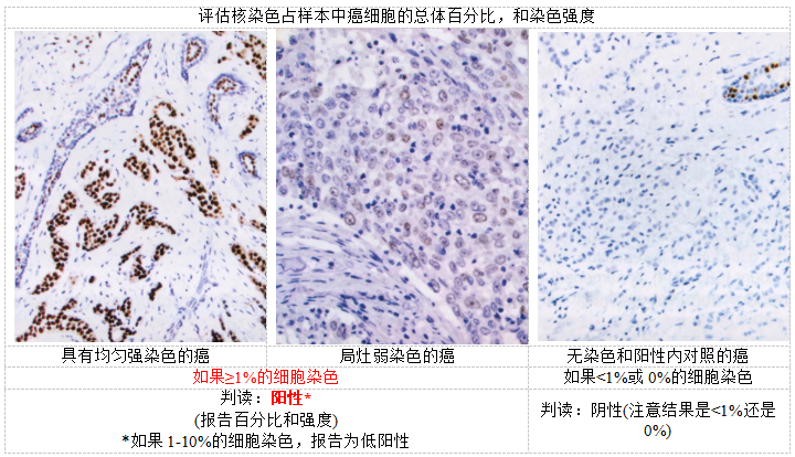 乳腺肿瘤WHO分类学习笔记（连载9）