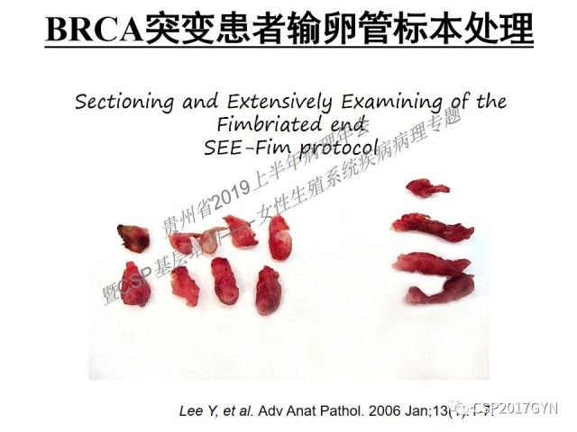 中华病理学会基层培训遵义站讲座（一）——卵巢和输卵管浆液性肿瘤的诊断和鉴别诊断