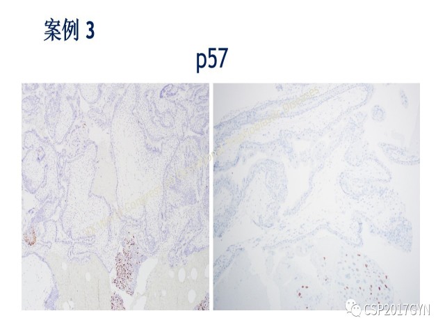p57免疫组化染色及基因分型 在葡萄胎精确诊断中的应用