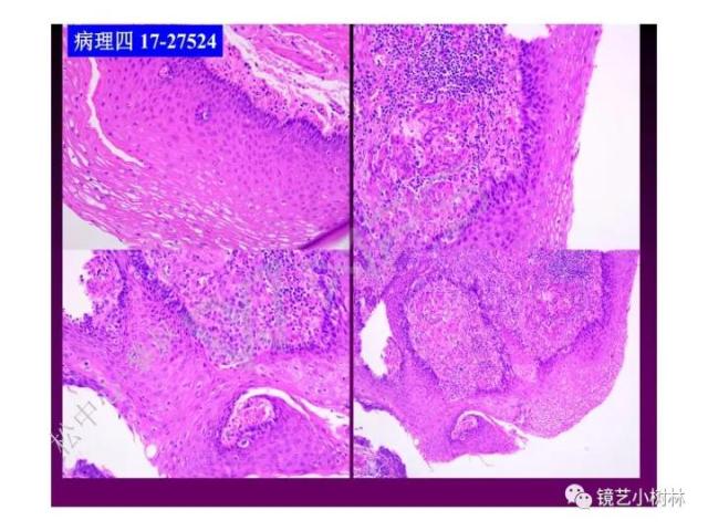 上消化道早癌病理的学习心得体会（附胃牵手癌的病例特点文献学习）