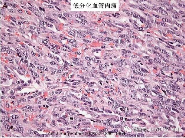 乳腺梭形细胞病变的病理诊断及进展（二）