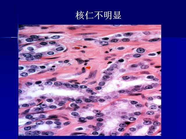 前列腺病理诊断线索（上）——黄教悌