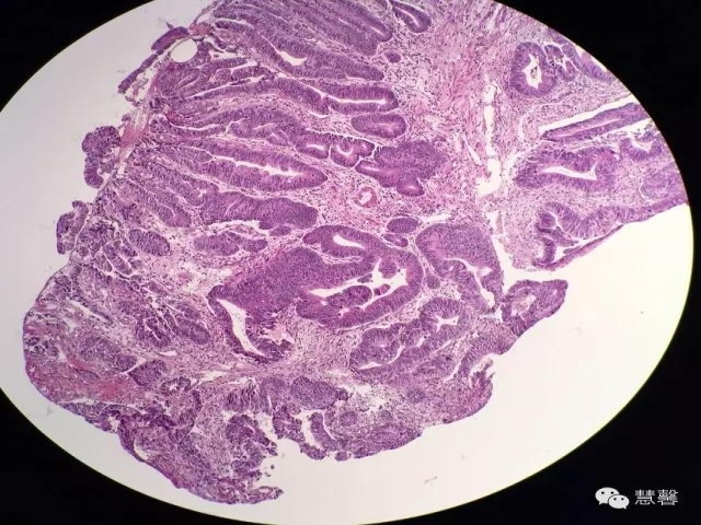 结、直肠管绒毛状腺瘤-高级别病变诊断等相关问题2（悄悄分享、孔祥田(Max)*Roswell*老师讲解）