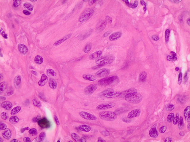 甲状腺透明梁状肿瘤概述 甲状腺透明梁状肿瘤概述