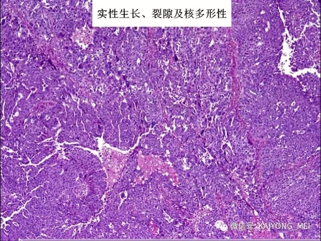 卵巢癌的病理诊断新进展（一）