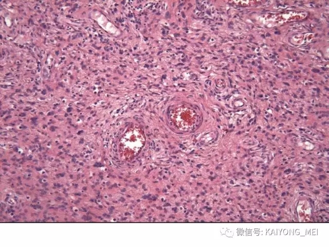 女性生殖道软组织肿瘤病理诊断及进展（一）