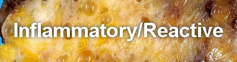 乳腺病理-炎症/反应性病变