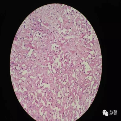 子宫内膜乳头状增生（甜甜分享病例，孔祥田(Max)*Roswell*老师讲解，kent翻译整理文献）