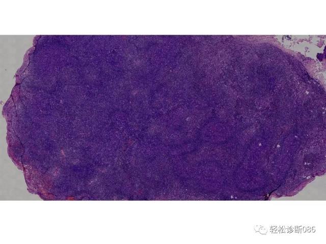 HIV/AIDS相关性LPDHIV感染相关淋巴瘤病例分析