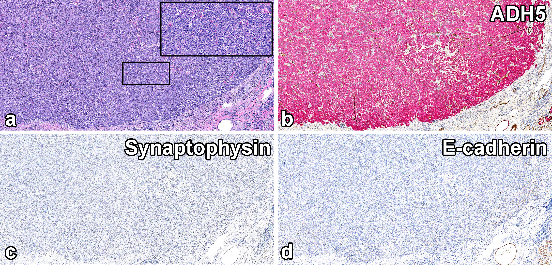 读文献，学病理-乳腺乳头状肿瘤难点总结（二）