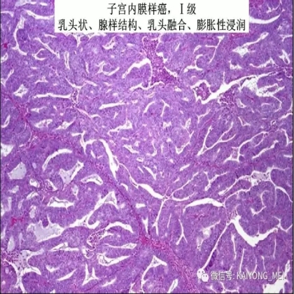 卵巢癌的病理诊断新进展（二）