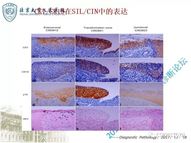 宫颈鳞状上皮内病变病理诊断中问题