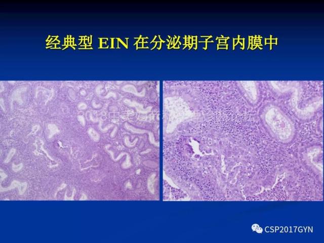 子宫内膜癌：诊断与进展