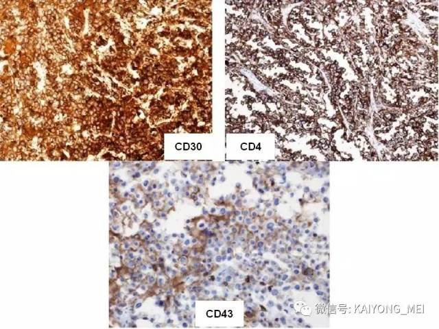 T细胞淋巴瘤病理诊断及进展（一）