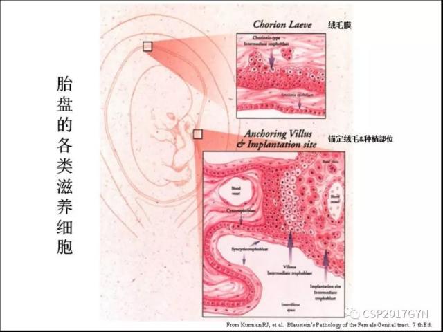 妊娠滋养细胞肿瘤的临床病理学进展