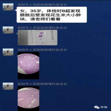 旺炽增生性膀胱炎？低级别尿路上皮癌？（吴龙云分享，孔祥田(Max)*Roswell*NM]讲解）