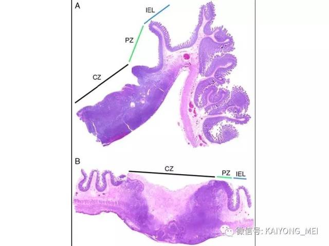 T细胞淋巴瘤病理诊断及进展（三）