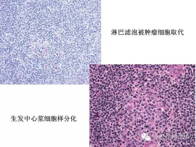 边缘区淋巴瘤（附小B细胞NHL鉴别诊断）