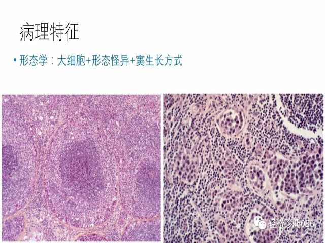 间变大细胞淋巴瘤