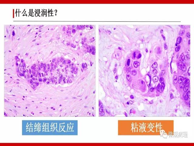 泌尿课程/浸润性尿路上皮癌病理学类型