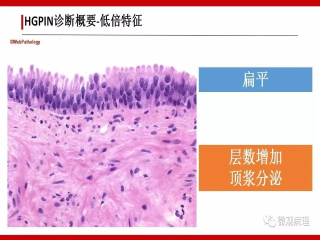 泌尿课程/一个中心,两个基本点:HGPIN诊断概要 泌尿课程/一个中心,两个基本点:HGPIN诊断概要