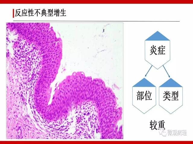 泌尿课程/非浸润性尿路上皮病变诊断的一些困惑
