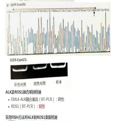 中日韩个体化诊疗案例大赛经典赏析之十——驱动基因双突变，两种靶向药物均无效，个体化治疗的阿克琉斯之踵