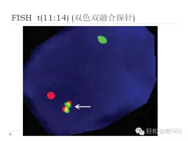 关于套细胞淋巴瘤的总结课件