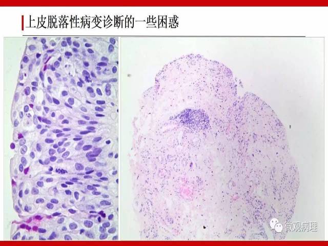 膀胱尿路上皮肿瘤诊断的一些困惑