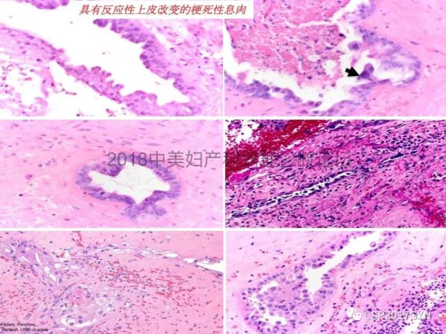 子宫内膜假肿瘤性病变及类似癌样病变
